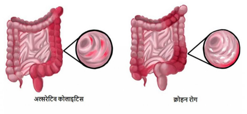inflammatory bowel disease (IBD)