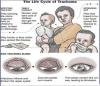 trachoma